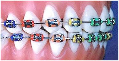 Aparat orthodontic fix metalic (ligaturare cu module elastice colorate/neutrale după preferinţe) 