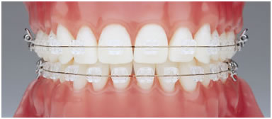 Aparat orthodontic fix fizionomic (ceramic)