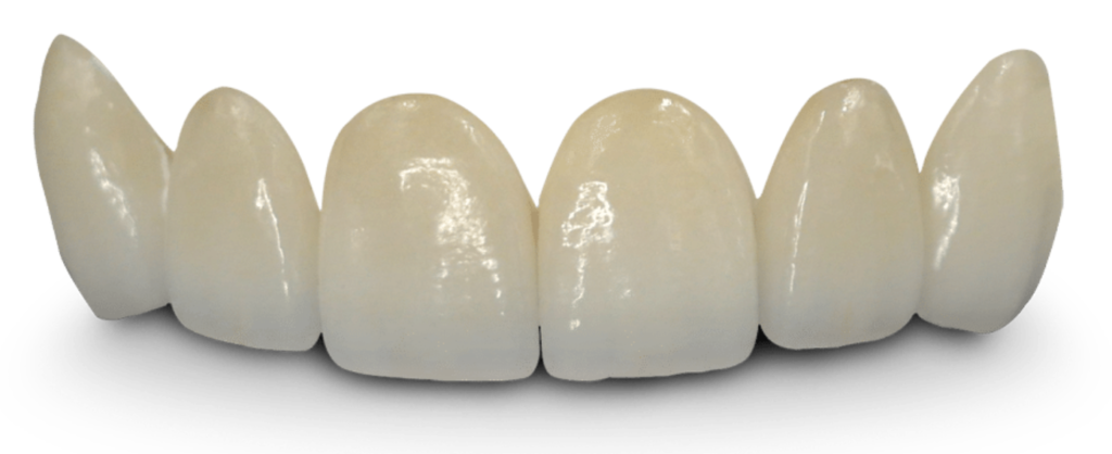 Coroane dentare din ceramică integrală